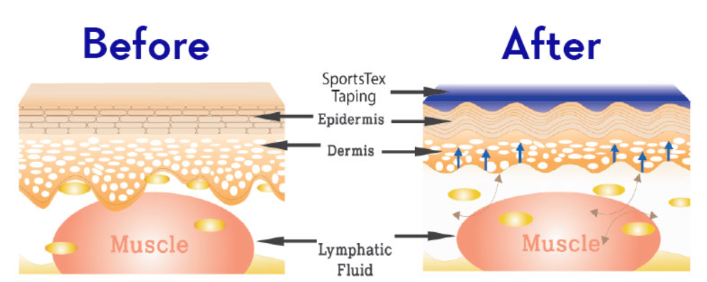 With SportsTex Tapes you can perform better with less pain